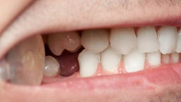 Die häufigsten Ursachen für Zahnverlust