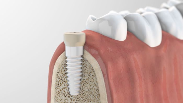 Keramikimplantate