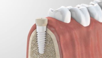 Stegprothese als ideale Kompromisslösung